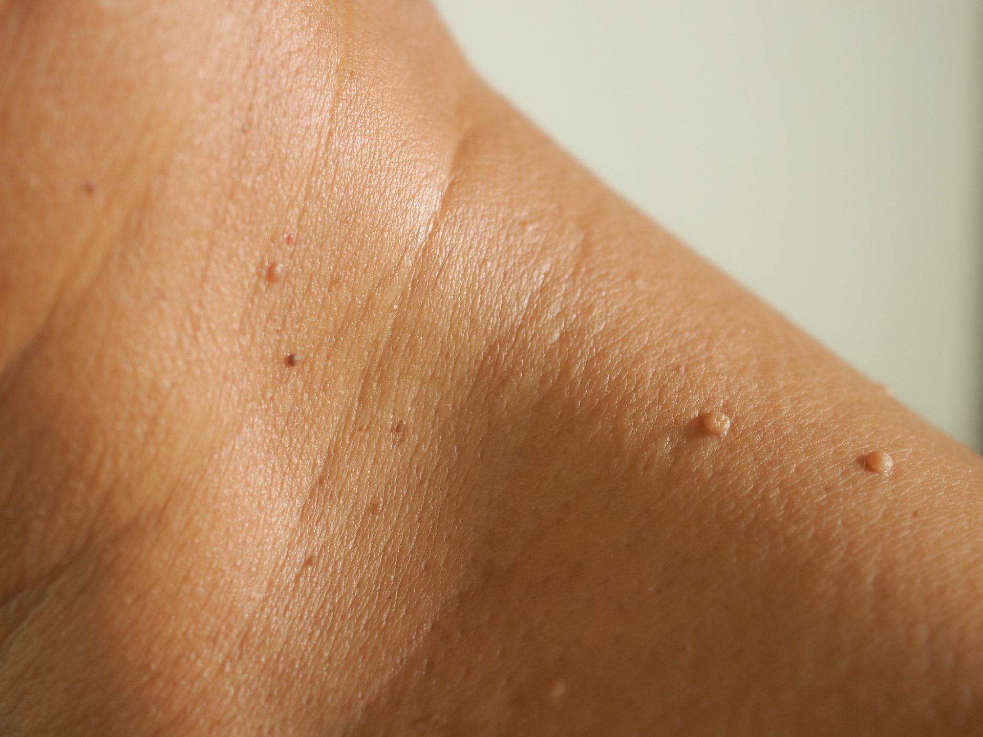 closeup of skin tags on patient's shoulder