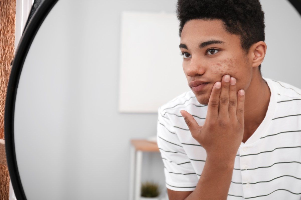 a young man is looking at himself on the mirror and touching his face with achne