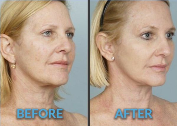 a before and after photo of a woman facing right. before photo on the left shows visible skin pigmentation on the cheek and right photo shows her skin glowing after getting laser resurfacing treatment 