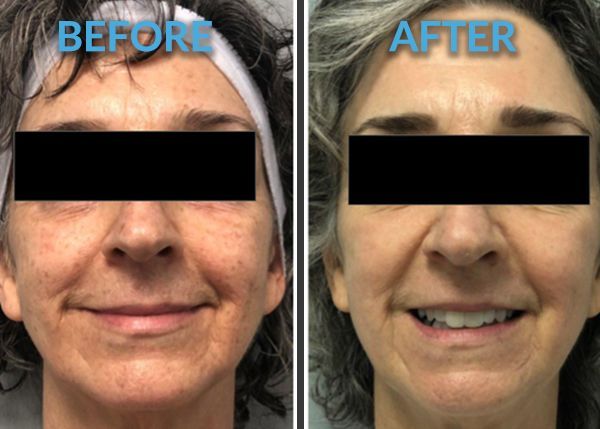a before and after photo of a woman's entire face with both her eyes covered by a black strip. Her face is now smoother and has less wrinkles and glowing after getting laser resurfacing treatment. 