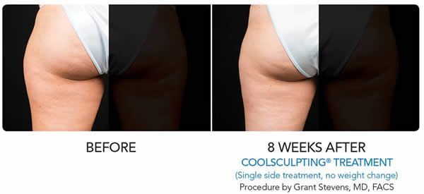 a woman's buttock is shown before and 8 weeks after a coolsculpting treatment