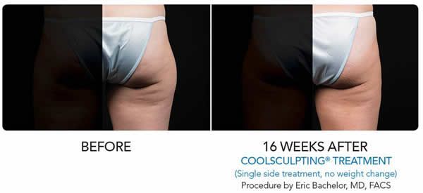 a woman's buttock is shown before and 16 weeks after a coolsculpting treatment
