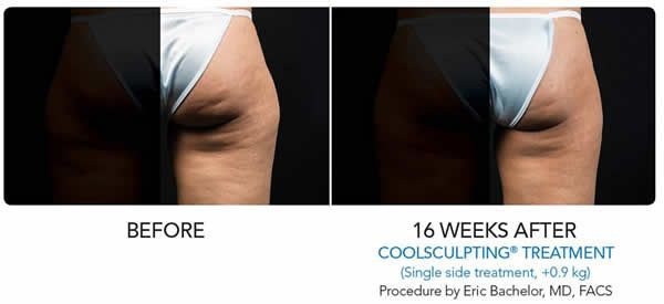 a woman's buttock is shown before and 16 weeks after a coolsculpting treatment