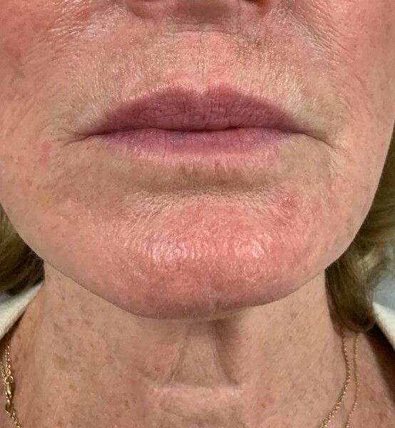 an after close up photo of an older woman 's mouth and chin. wrinkles and sagging are no longer visible