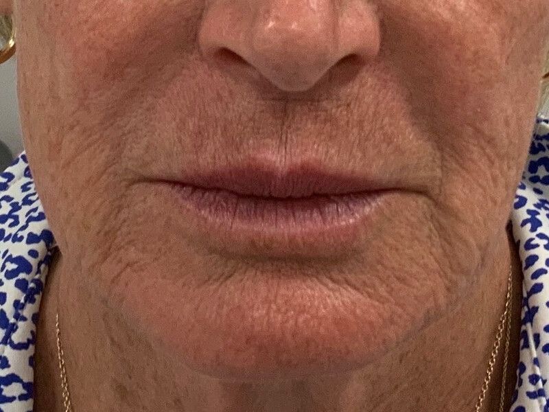 a before close up photo of an older woman 's mouth and chin. wrinkles and sagging are visible