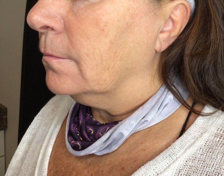 profile photo showing the lower half of the woman's face showing visible lifting after RF microneedling