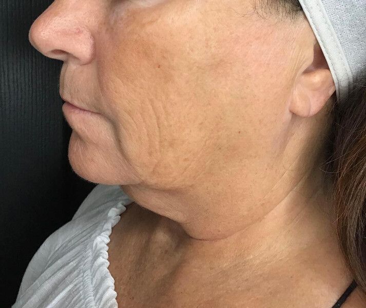 profile photo showing the lower half of the woman's face showing sagging and wrinkles