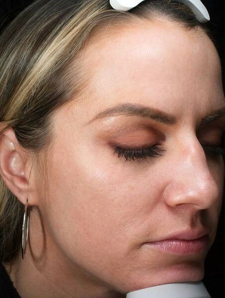 a close up of a woman 's face facing down  3/4 left with her eyes closed. After microneedling. 