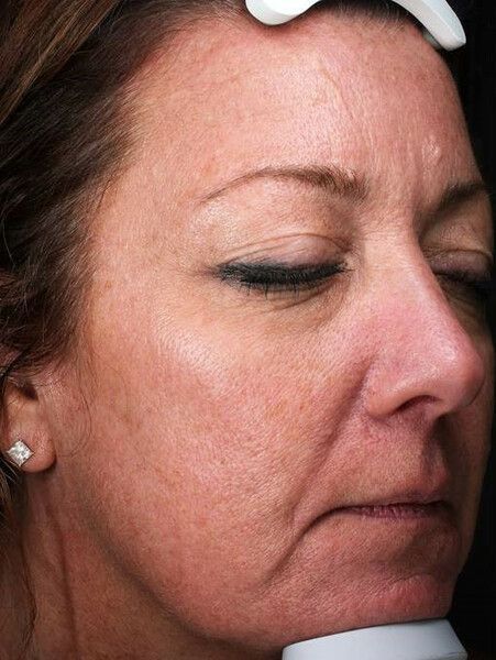 a close up of a woman 's face facing 3/4 left with her eyes closed. After microneedling.