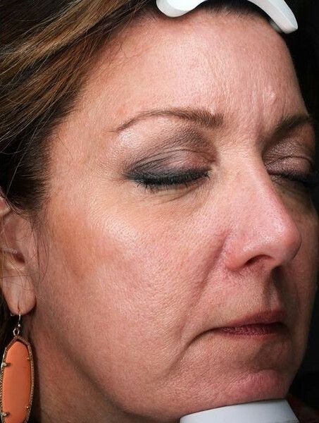 a close up of a woman 's face facing 3/4 left with her eyes closed. before RF microneedling. 