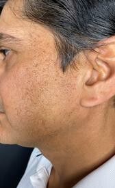 profile photo showing the upper half of the man's face after RF Microneedling. Face is now more lifted and scars less visible