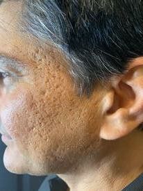 profile photo showing the upper half of the man's face showing visible sagging and Ice pick scars.