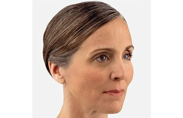 a close up of a woman 's face without makeup after Juvederm treatment
