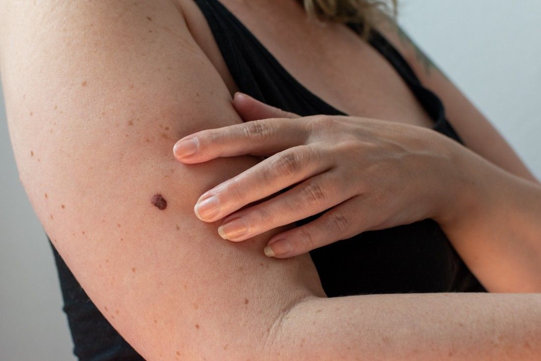 a woman is touching her arm with her hand next to a bumpy spot