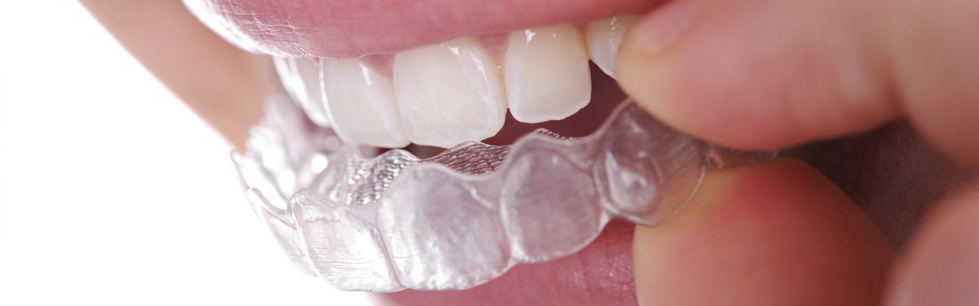 Clear aligners