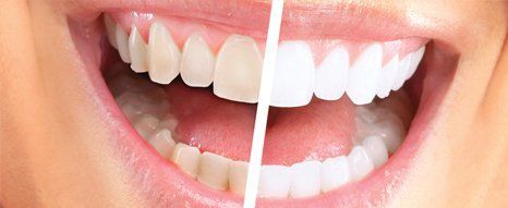 Teeth whitening and fitting of veneers