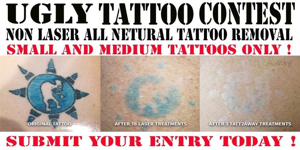 Tattoo Removal In Columbus Ohio Tattoo Removal Columbus