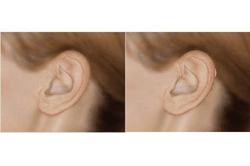 apparecchio per l'udito invisibile