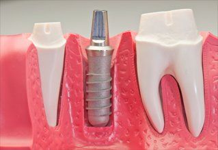 close up of a implant model