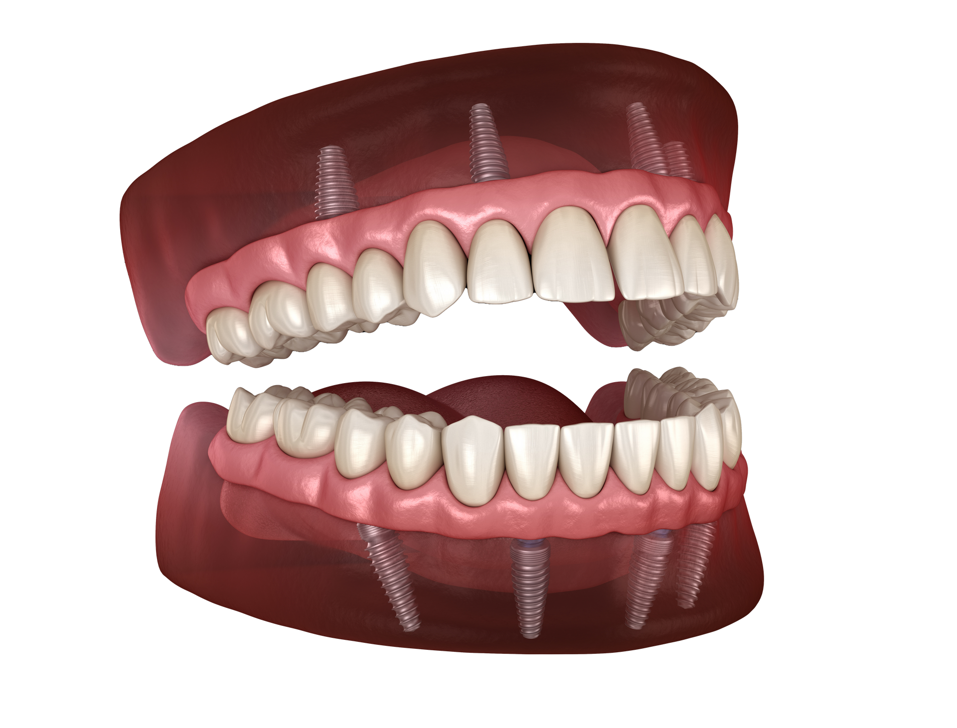 Dentures attached to dental implants in upper and lower jaws; model shows teeth and gums.