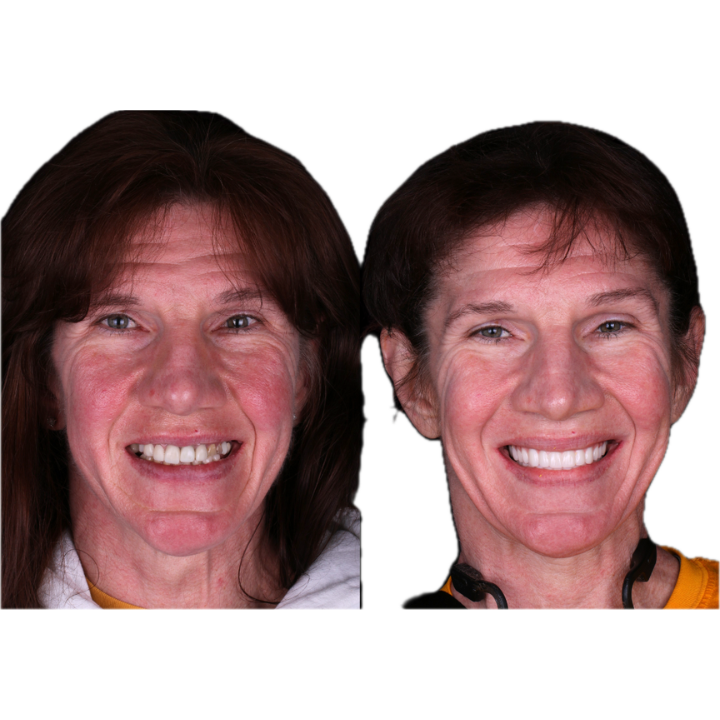 Two photos side-by-side show a woman's smile with her natural teeth and with a new dental procedure.