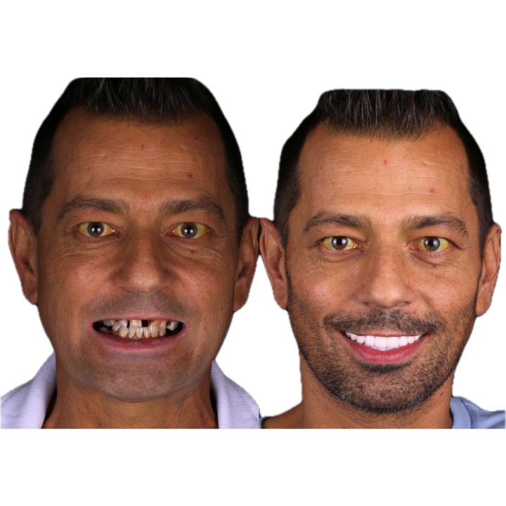 Before and after dental work: Man with missing teeth smiling with new, white teeth.