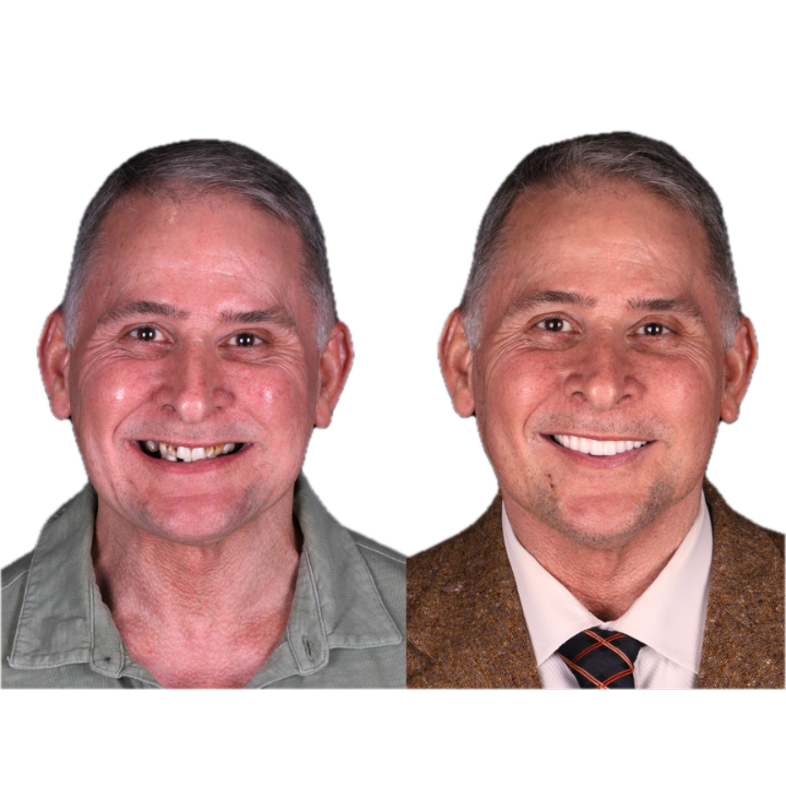 Before and after photos of a man; left shows missing teeth, right shows a bright, new smile.