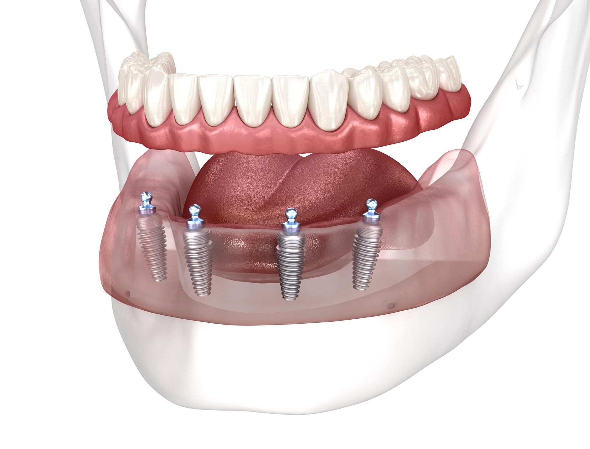 Dental implant model showing lower jaw with implants, a denture, and upper teeth.