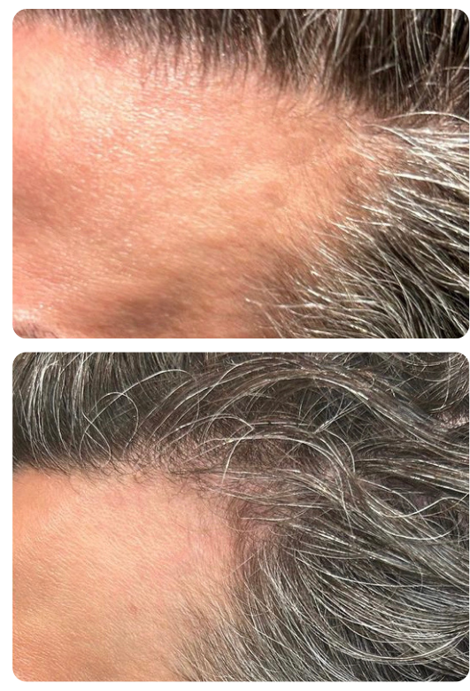 Before and after images showing hair growth around the hairline. 