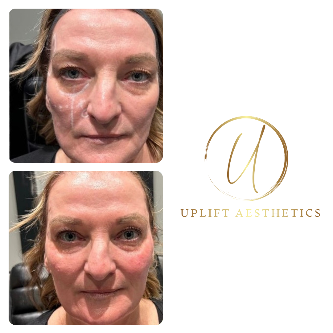 Before and after photos of a patients filler treatment.