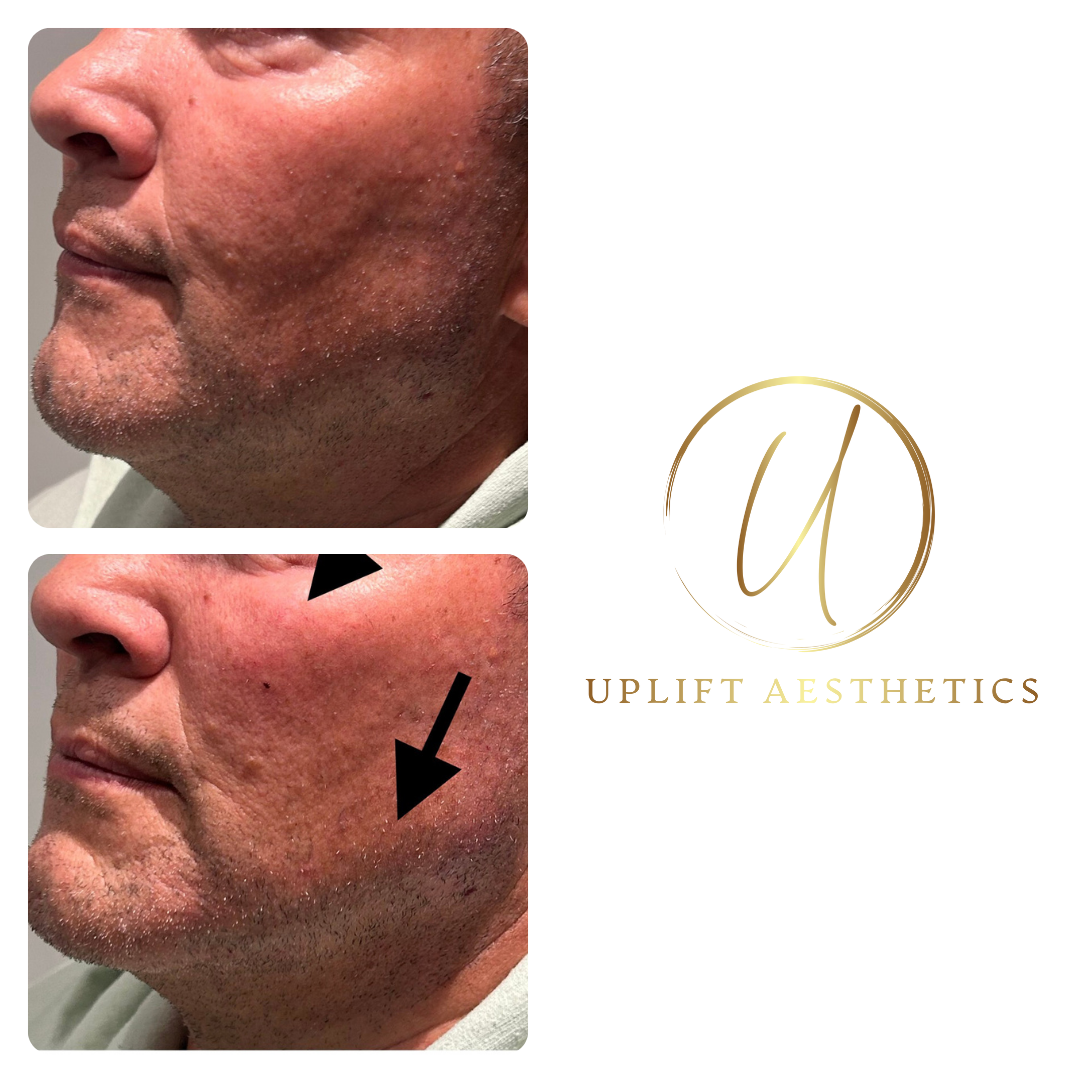 Before and after shows a reduction in jowling, improved skin tone, with arrows highlighting the structural change.