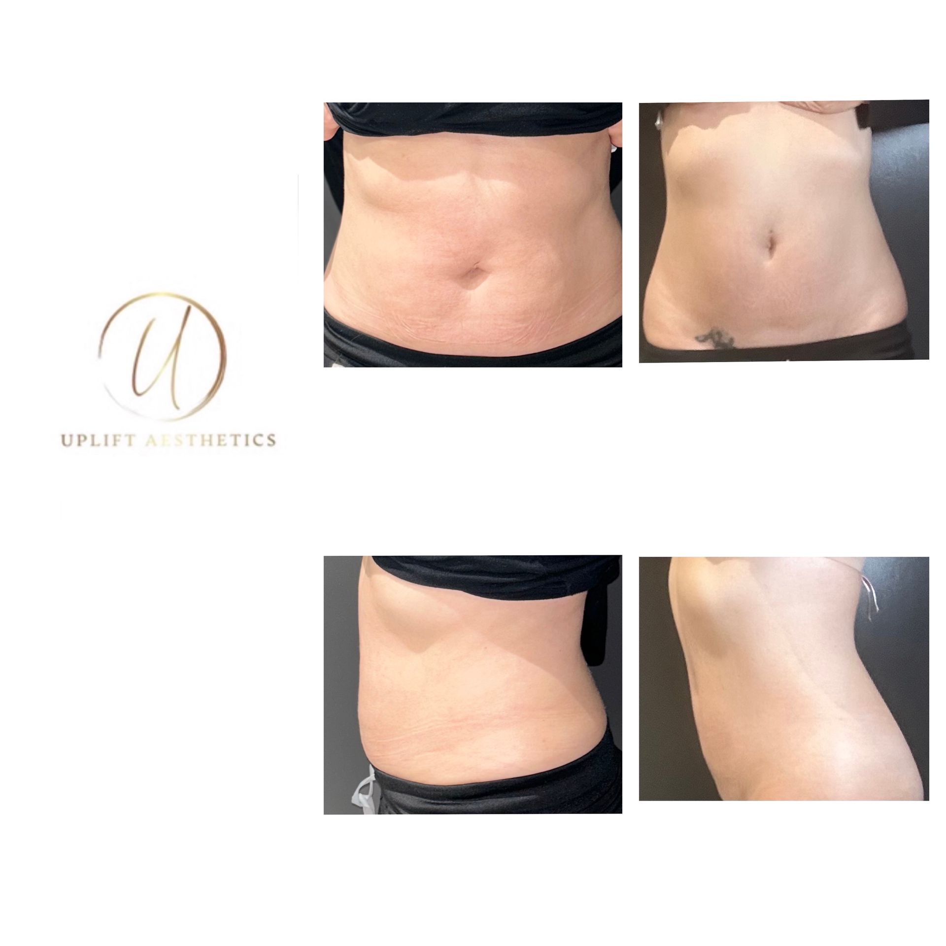 Before-and-after photos of a patient's abdomen.