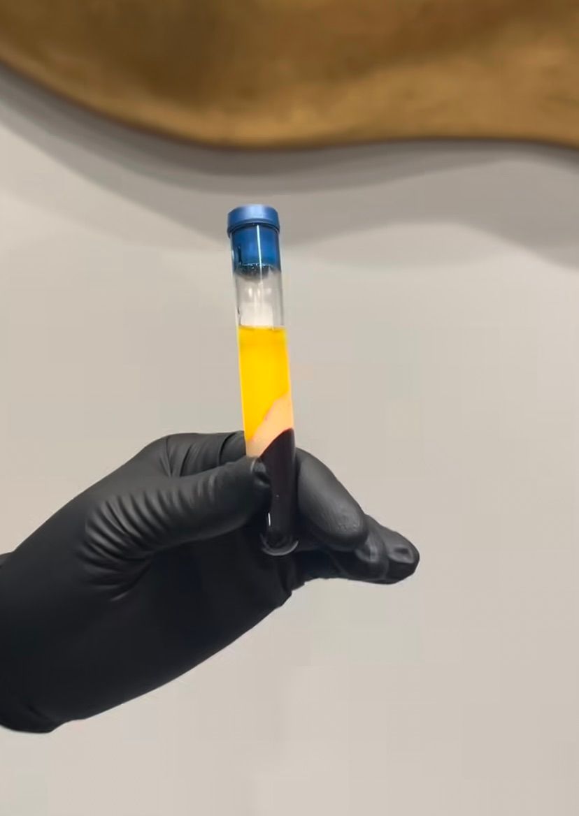 Holding PRP prior to treatment