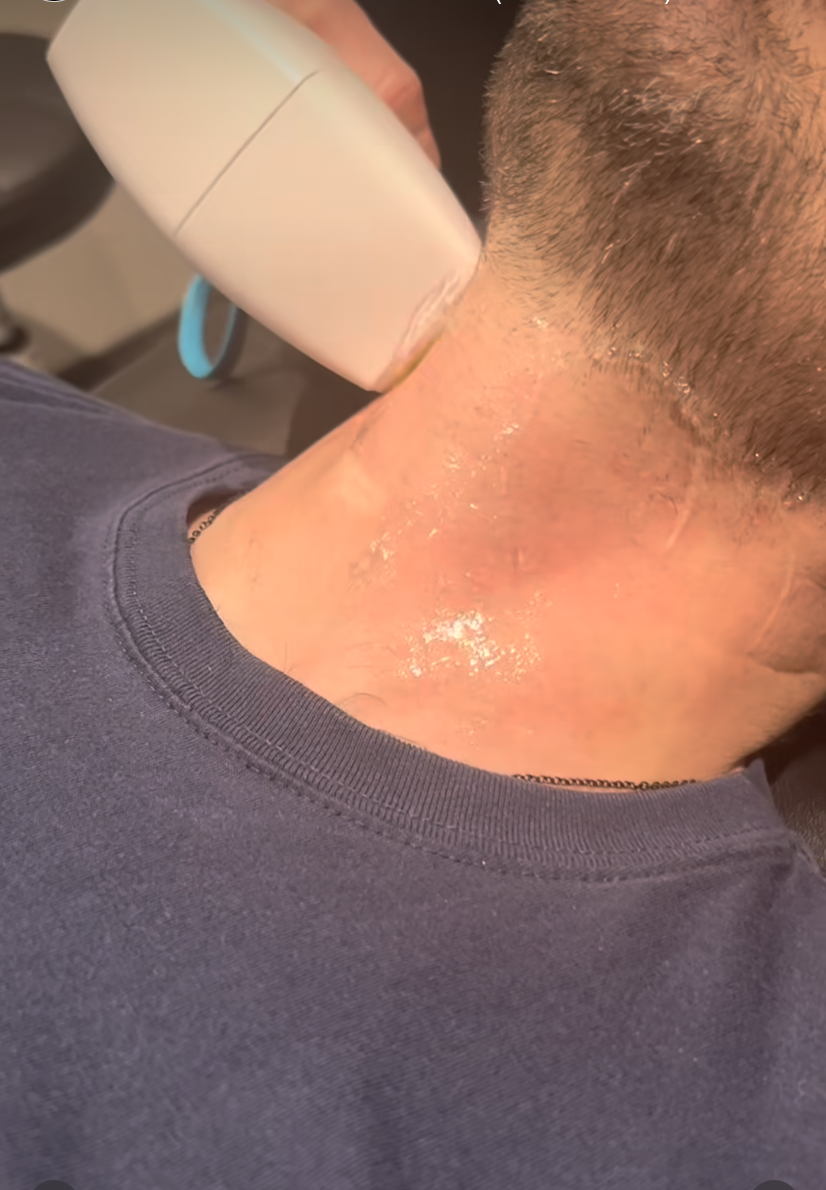 Patient receiving neck hair removal treatment with a handheld laser device.