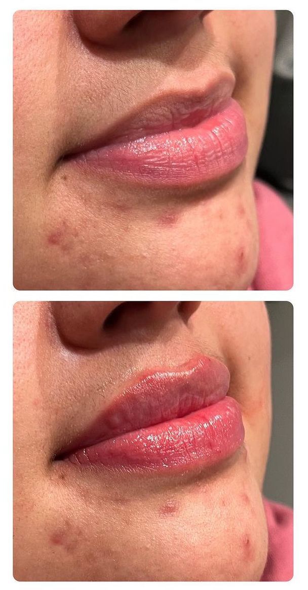 Two photos of lips, top view smaller, bottom view larger; slight fullness.