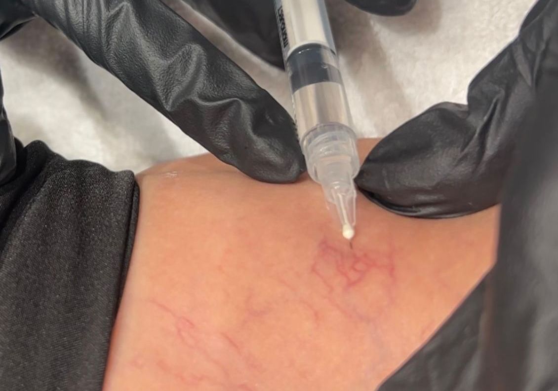 Patient receiving tox on her forehead