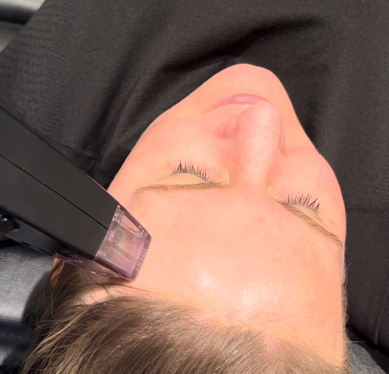 Woman's face receiving a cosmetic skin treatment on the forehead; device close up.