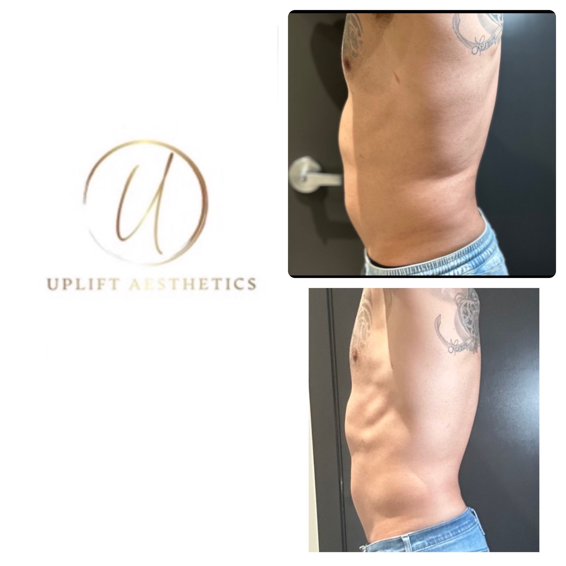 Before and after photos of a patient's abdomen after Emsculpt Neo