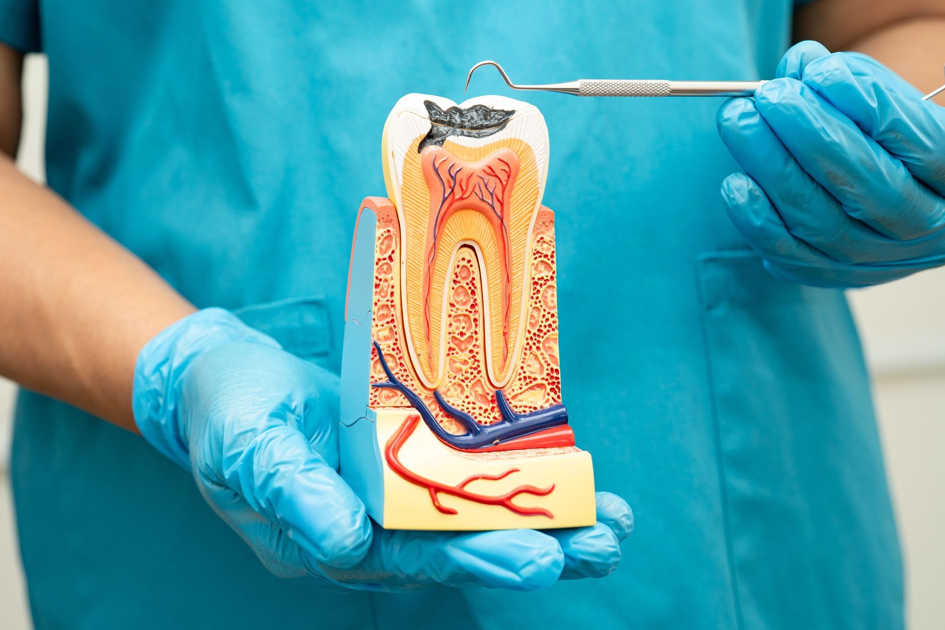 Dentist holding a cross-section tooth model showing a cavity, using a dental tool.