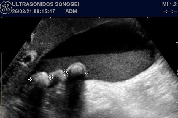 ULTRASONIDO SONOGENIK