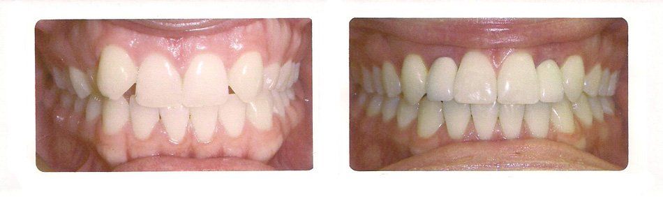 Before and After of Teeth — Alliance, OH — Kristine Sigworth, DDS