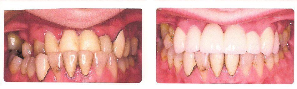 Before and After of Stained Teeth — Alliance, OH — Kristine Sigworth, DDS