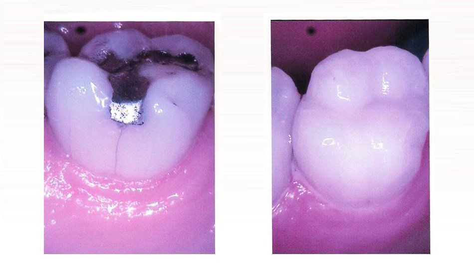 Before and After of Tooth — Alliance, OH — Kristine Sigworth, DDS