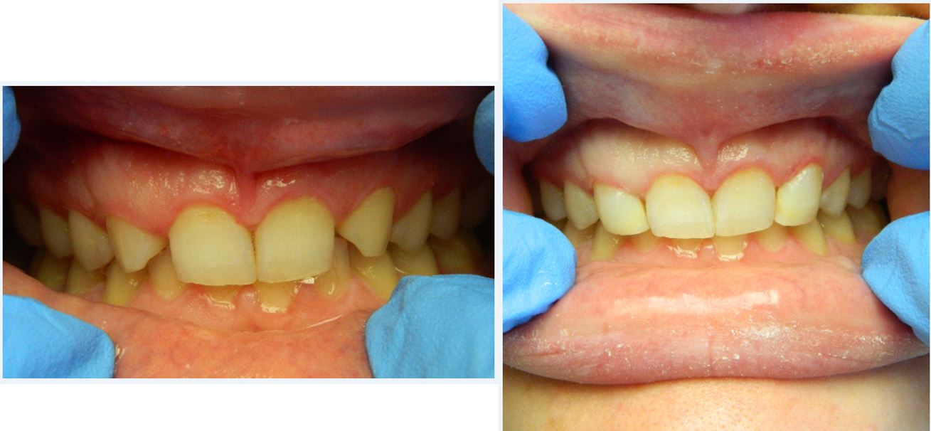 Before and After of Crack Teeth — Alliance, OH — Kristine Sigworth, DDS