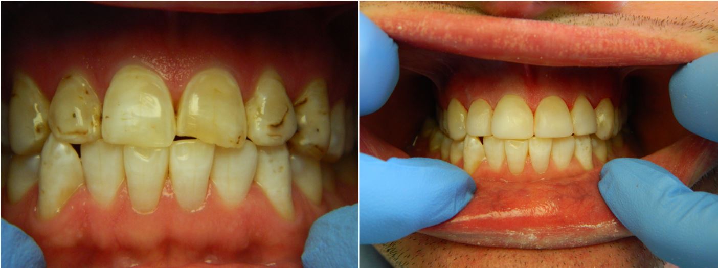Before and After of Teeth Gap Filling — Alliance, OH — Kristine Sigworth, DDS