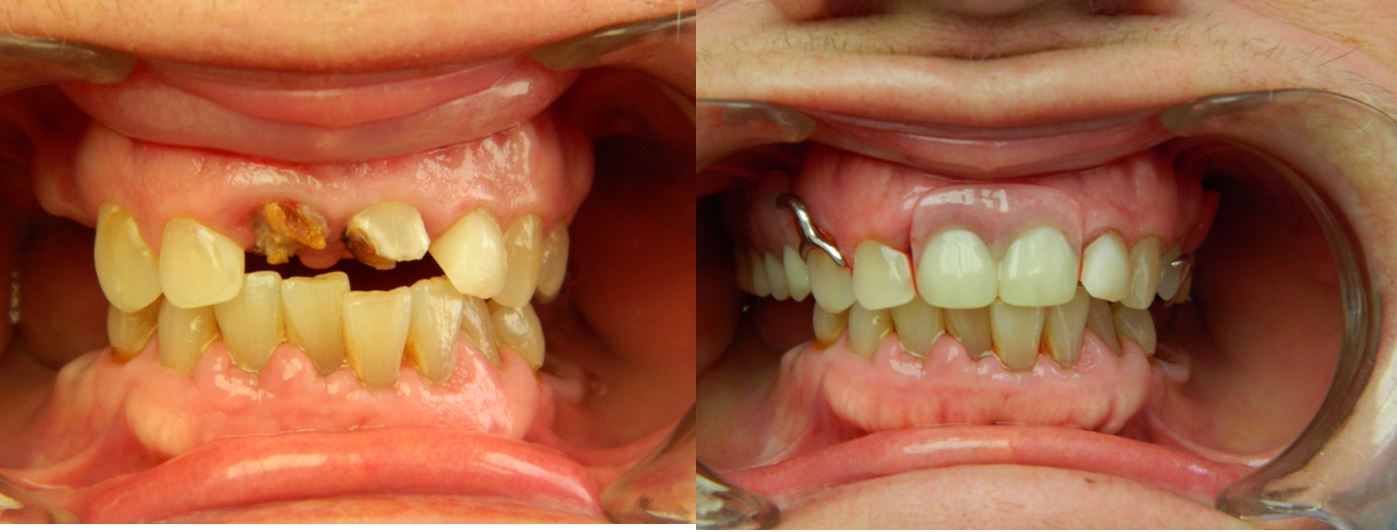 Before and After of E-Max Service — Alliance, OH — Kristine Sigworth, DDS