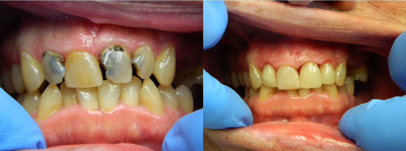 Before and After of Discolored Teeth — Alliance, OH — Kristine Sigworth, DDS