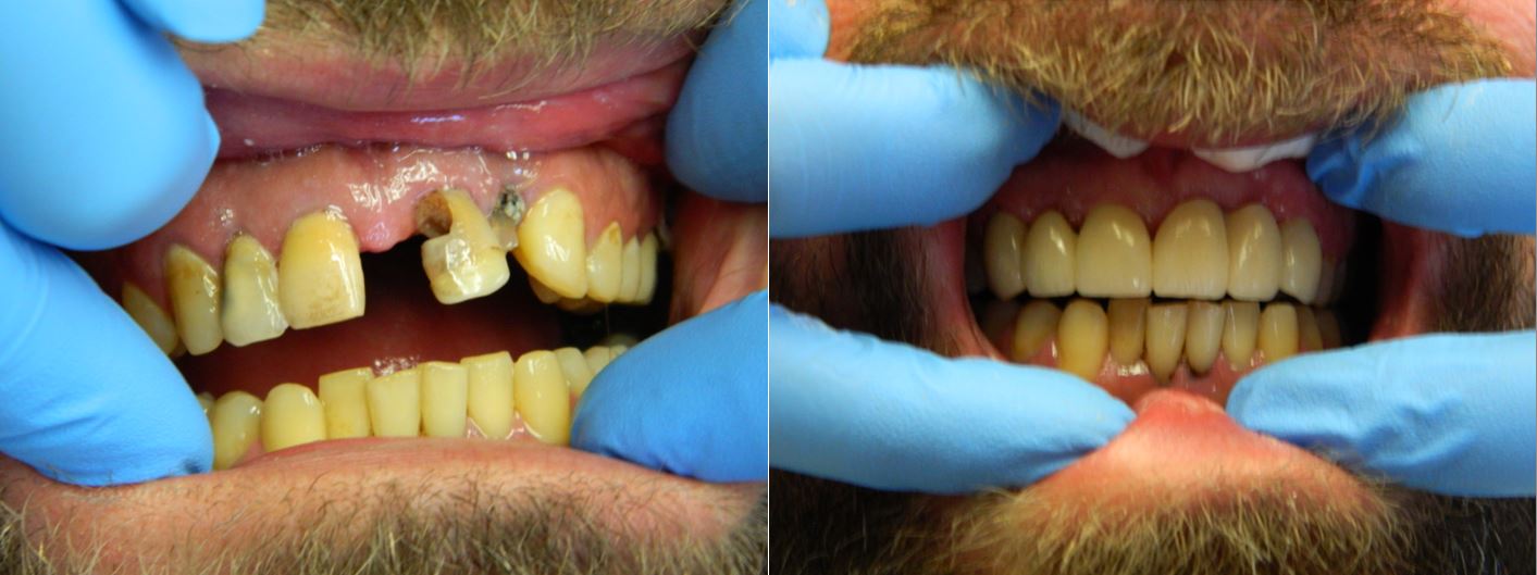 Before and After of E-Max — Alliance, OH — Kristine Sigworth, DDS