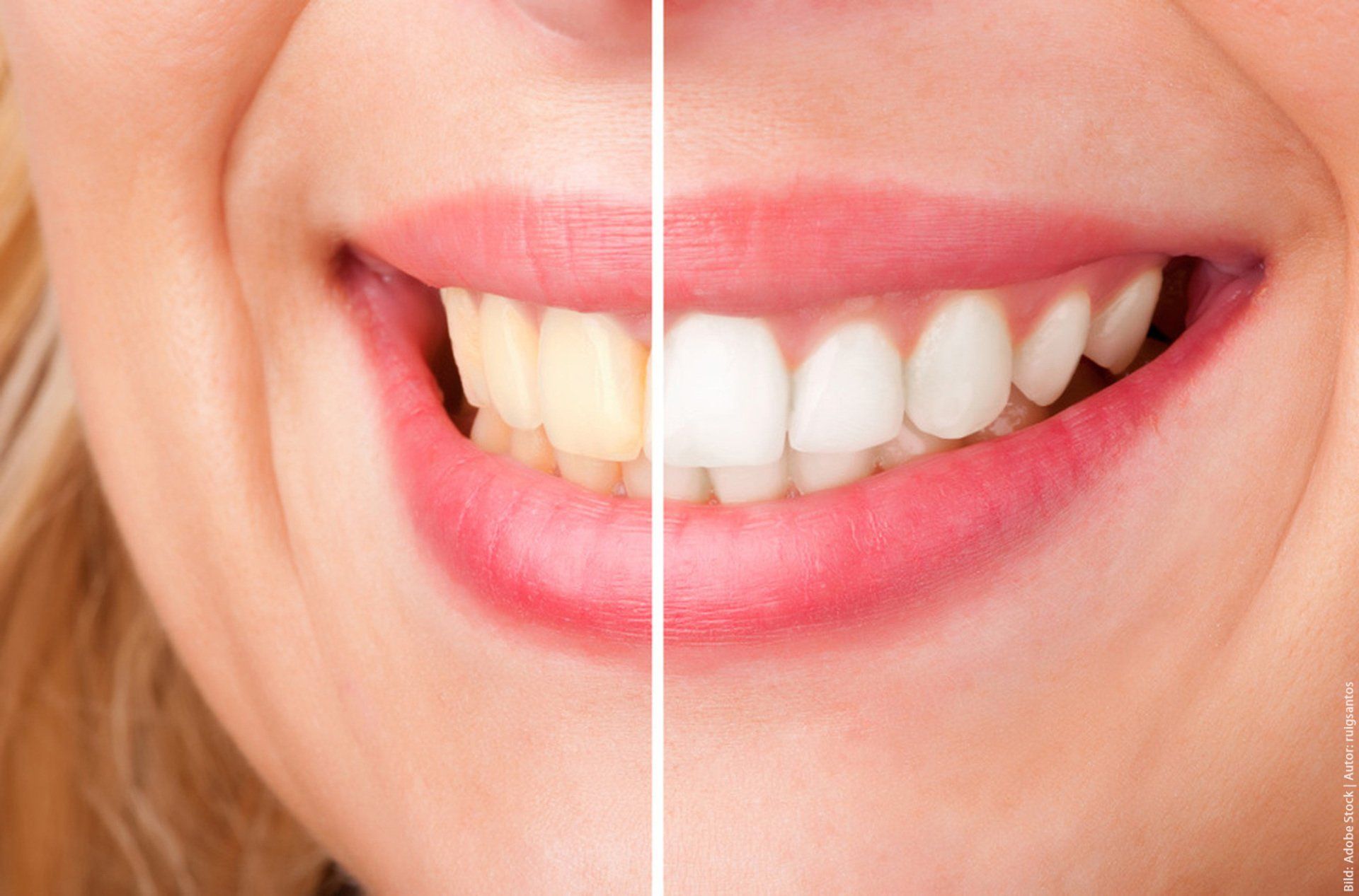 A close up of a woman's teeth before and after whitening.