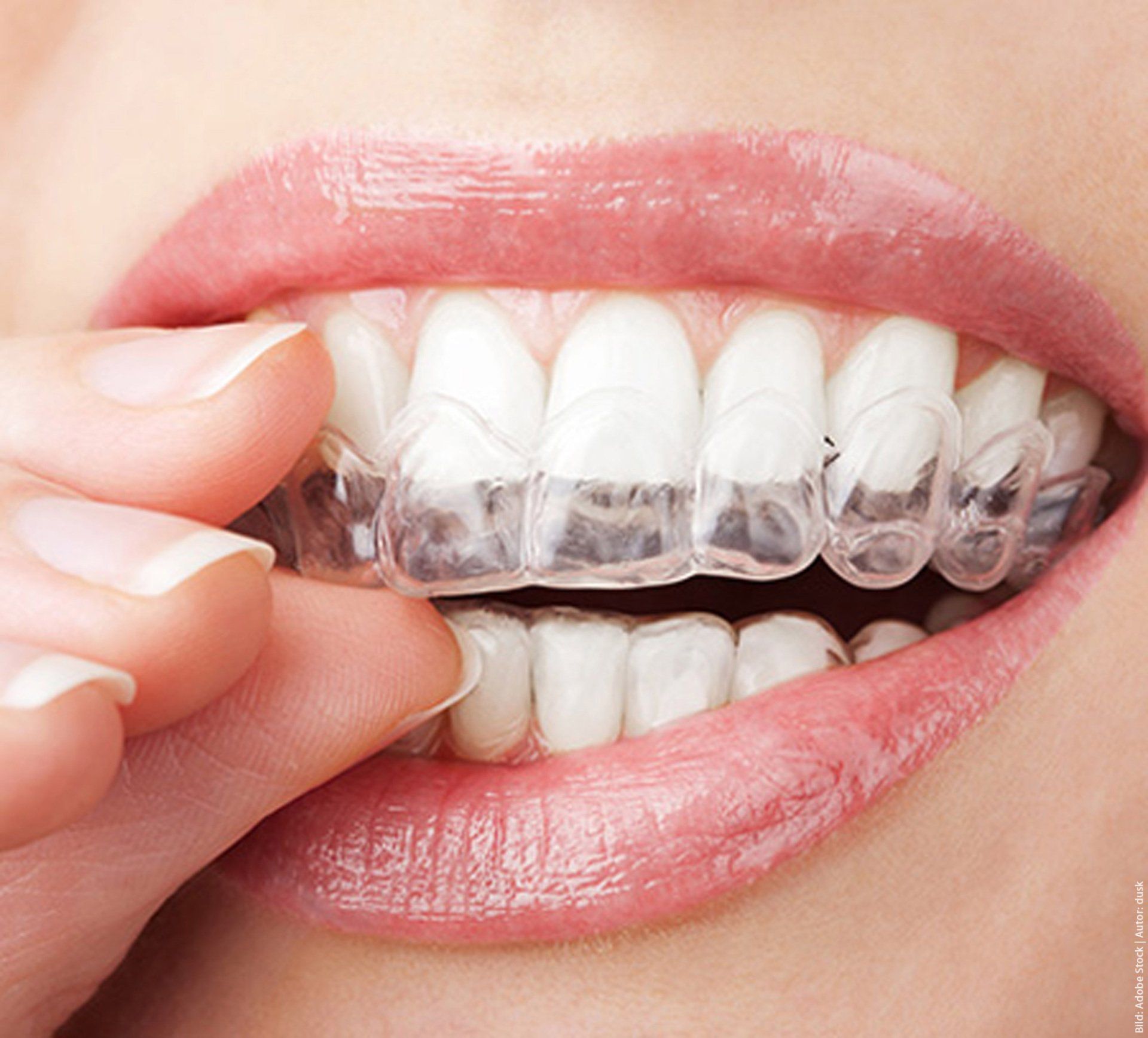 A woman is putting a clear brace on her teeth.